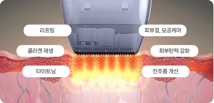 비침습형 고주파