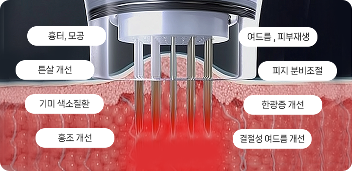 침습형 고주파